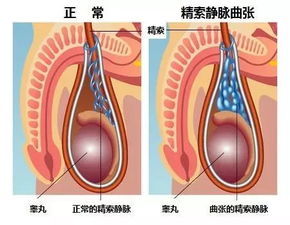 精索静脉曲张症，病因、症状与治疗详解