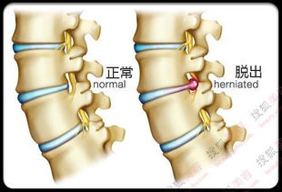 腰间盘突出的症状全面解析，如何识别与应对