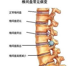 腰间盘突出的症状全面解析，如何识别与应对