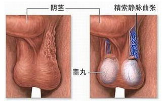 精索静脉曲张症状详解，男性的隐秘之痛