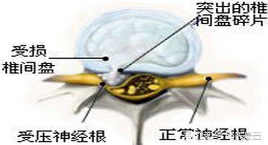 腰椎间盘突出的症状与自我诊断方法