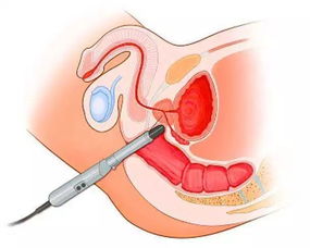 前列腺炎的自我检测与康复指南