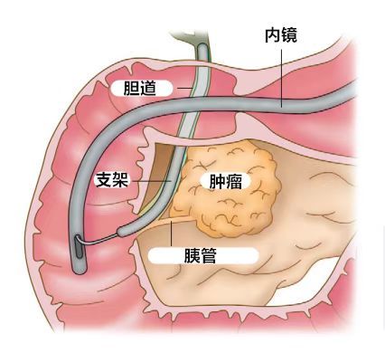 神经衰弱有什么症状？全面解析与自我调适指南