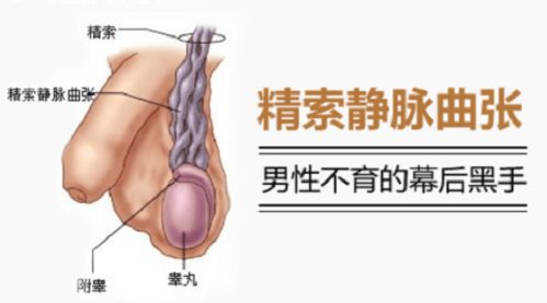 全面解析精索静脉曲张手术后的恢复与注意事项