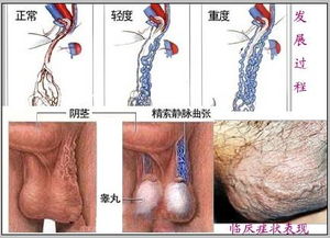 全面解析精索静脉曲张手术后的恢复与注意事项