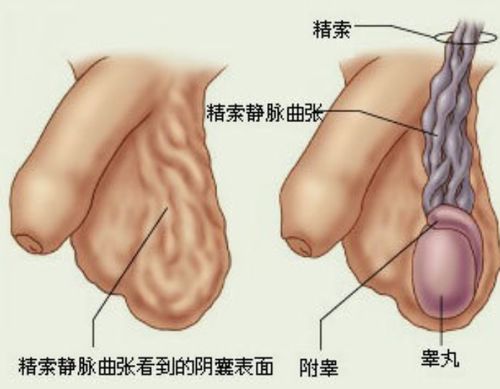 全面解析静脉曲张的成因、症状及防治方法