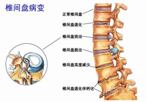 强直性颈椎病，全面解析病因、症状与防治方法