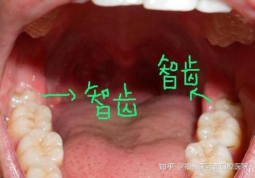 长了智齿一定要拔吗？——全面解析智齿的去留问题