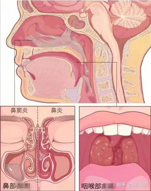 嗓子痒咳嗽怎么办？——全方位解决你的喉咙不适