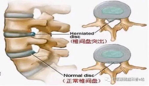 科学运动告别腰痛，腰椎间盘突出者的锻炼指南