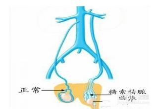 精索静脉曲张的症状详解与自我检测